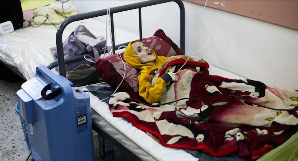 Late Palestinian child Yazan Kafarneh on his hospital bed in Rafah before being starved to death due the Israeli genocidal and starvation war, southern Gaza. (AP)
