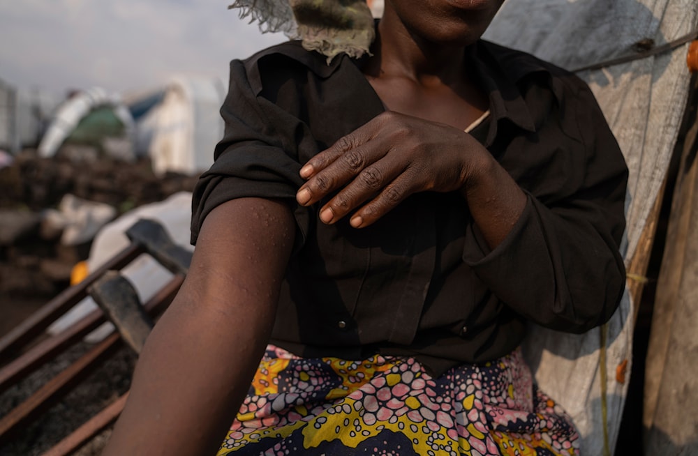 Sarah Bagheni, in the Bulengo refugee camp in Goma, Congo, suspects she may be infected with Mpox after the World Health Organization had declared Thursday, Aug, 15, 2024 (AP)