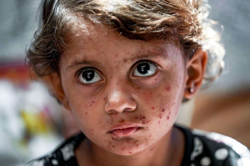 Forcibly displaced Palestinian child Toleen Marshoud, who suffers from skin disease, sits at a makeshift tent camp in Deir al-Balah, central Gaza Strip, Monday July 29,2024. (AP)