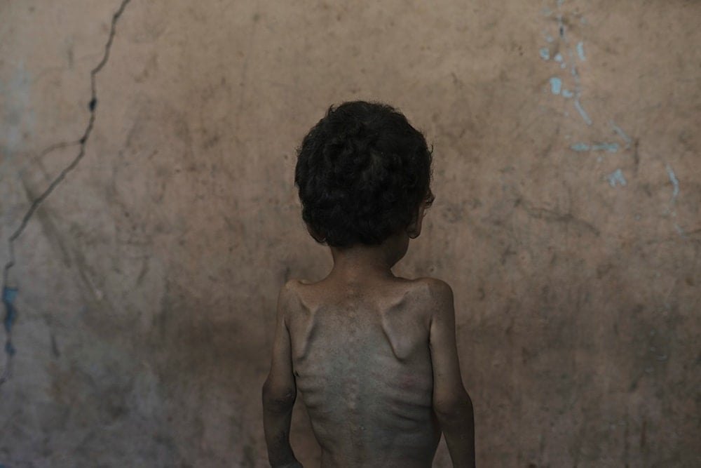 FILE.- Yazan Abu Ful, a 2-year-old malnourished child, poses for a photo at his family home in the Shati refugee camp, in Gaza City on Wednesday, July 23, 2025. (AP Photo/Jehad Alshrafi,File)