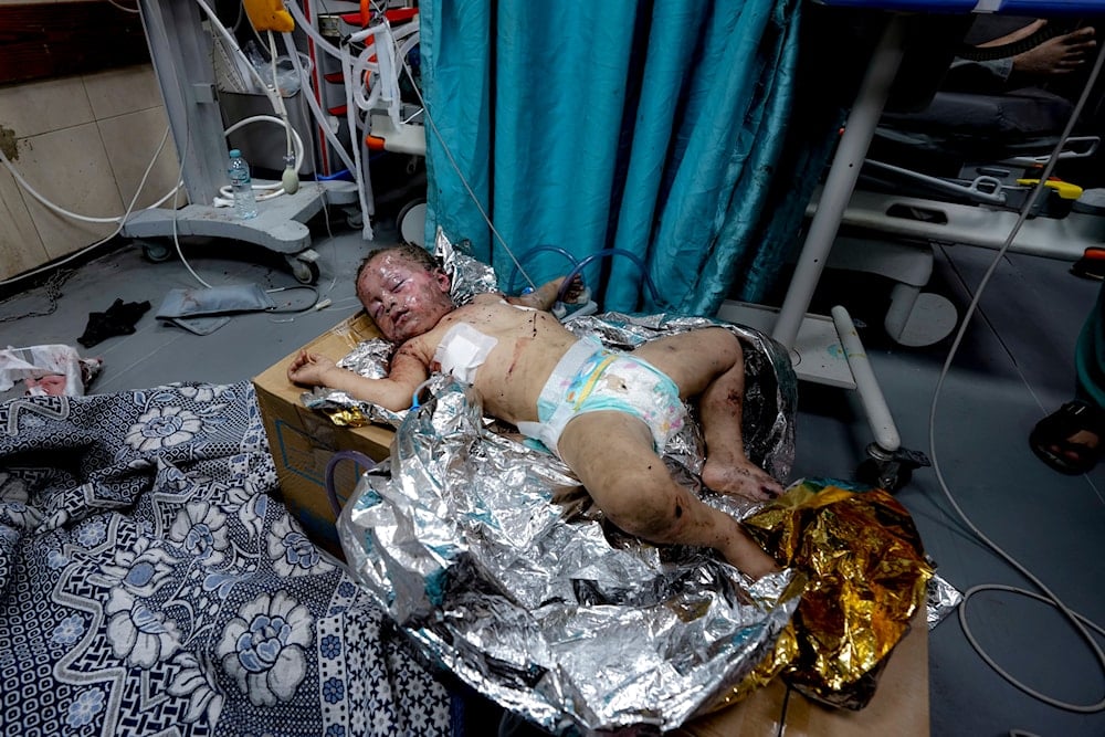 Palestinian Child Siwar Abdel-Hadi, 2, wounded in the Israeli bombardment of the Gaza Strip, lies at a hospital in Deir al-Balah, Tuesday, July 23, 2024.