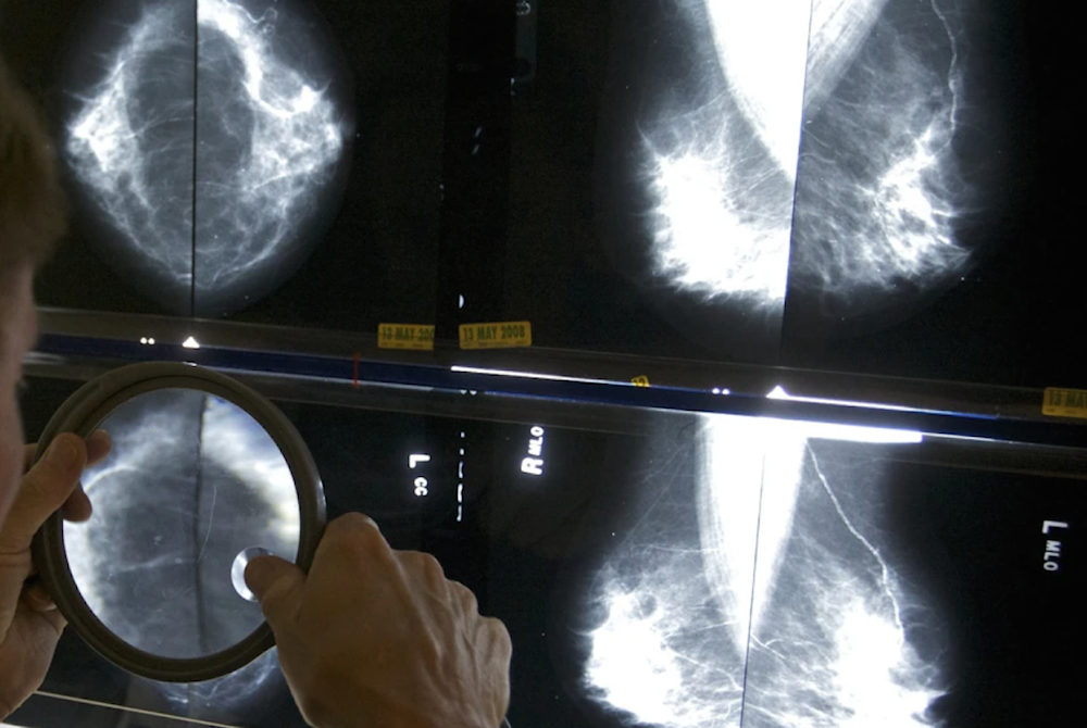 Senate report reveals Trump slashed cancer research by 31% 