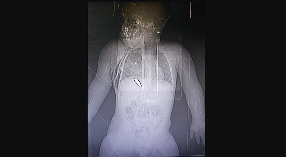 This 1.5 year old girl who was shot by a bullet close to GHF's aid site while in her mother's arms. (The Glia Project: X, @Glia_Intl) 