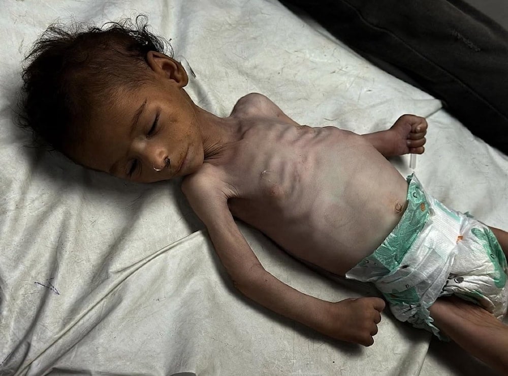 More than 70 children are reported to have died from famine and malnutrition in Gaza. (X, @mhdksafa)