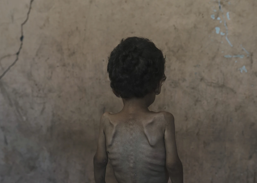 Yazan Abu Ful, a 2-year-old malnourished child, poses for a photo at his family home in the Shati refugee camp in Gaza City on July 23, 2025. (AP)