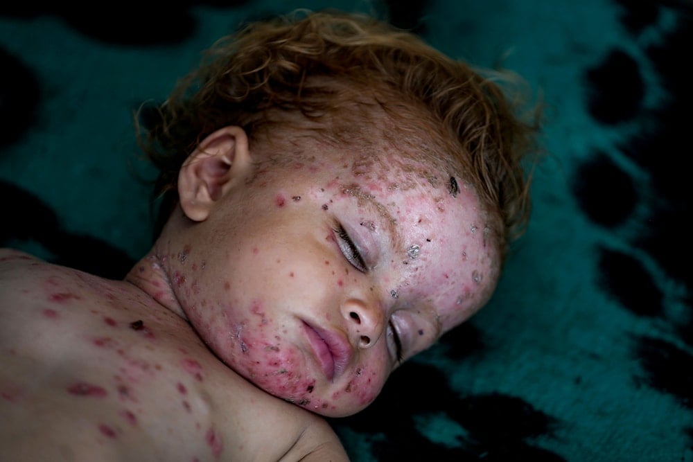 Gaza heatwave deepens crisis as skin diseases surge