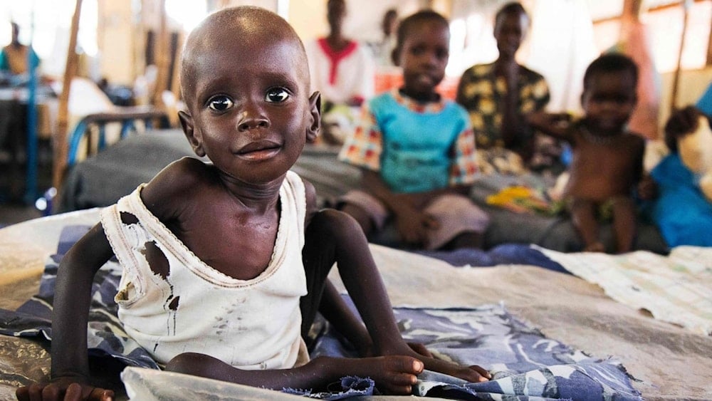 Aleo Tong, 1, who suffers severe malnutrition, rests on a bed at the MSF Nutrition Center in Aweil Hospital, August 2, 2016. (ALBERT GONZALEZ FARRAN/AFP/Getty Images)